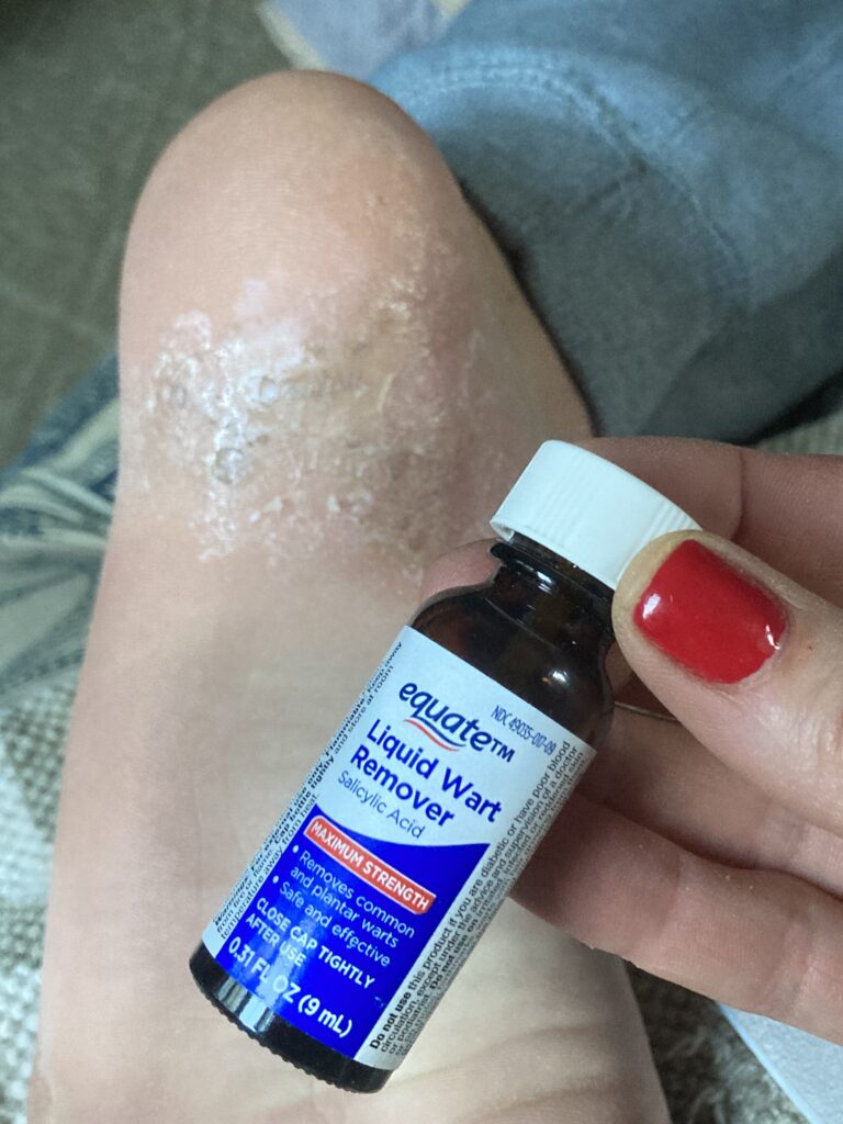 bottle of liquid wart remover medication held in front of heel with warts